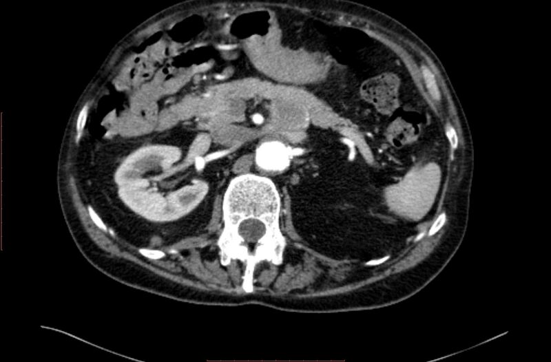 File:Abdominal aortic interposition tube graft and aneurysm thrombosis (Radiopaedia 71438-81857 Axial C+ arterial phase 37).jpg