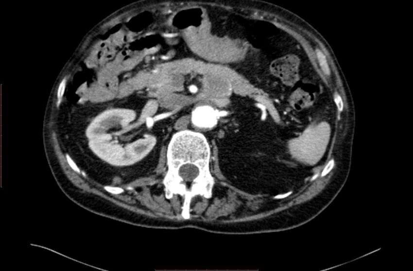 Abdominal aortic interposition tube graft and aneurysm thrombosis (Radiopaedia 71438-81857 Axial C+ arterial phase 37).jpg