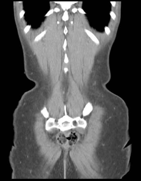 File:Abdominal desmoid tumor (Radiopaedia 41007-43740 Coronal C+ portal venous phase 37).png