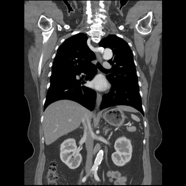 File:Aberrant right subclavian and left vertebral arteries (Radiopaedia 43467-46847 Coronal C+ portal venous phase 50).jpg