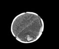 Abusive head trauma (Radiopaedia 70205-80252 Axial non-contrast 24).jpg