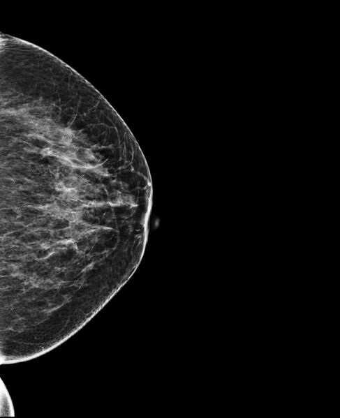 File:Accessory breast tissue (Radiopaedia 74571-85500 D 1).jpg
