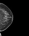 Accessory breast tissue (Radiopaedia 74571-85500 D 1).jpg