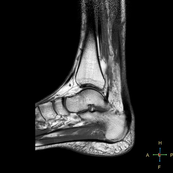 File:Achilles tendon complete tear (Radiopaedia 22834-22854 Sagittal T1 11).jpg