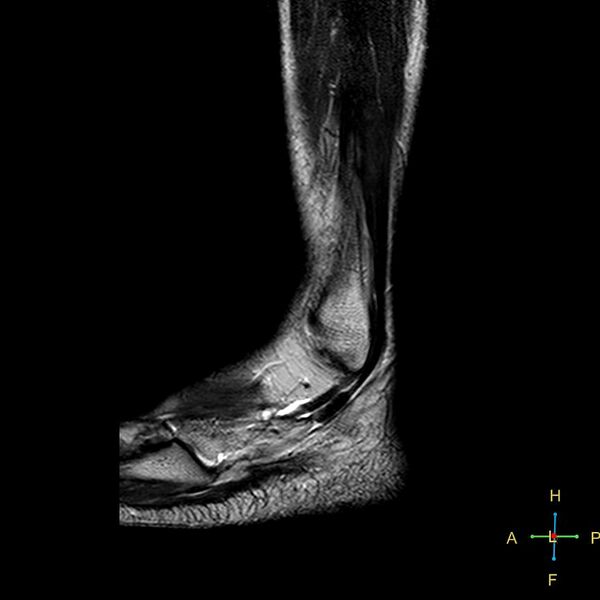 File:Achilles tendon complete tear (Radiopaedia 22834-22854 Sagittal T2 1).jpg