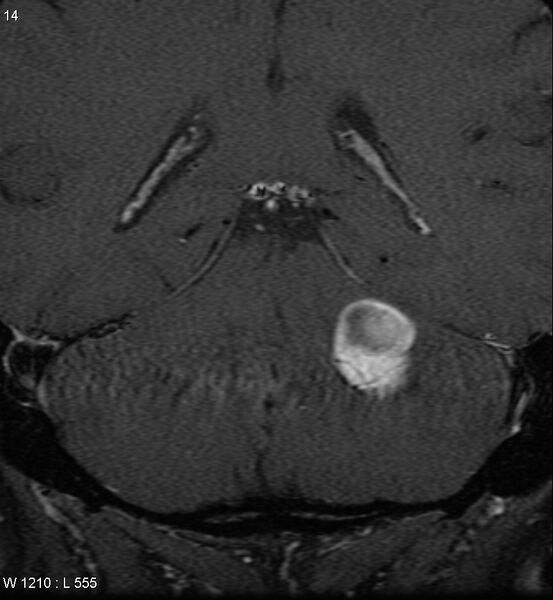 File:Acoustic schwannoma (large with cystic change) (Radiopaedia 5369-7130 Coronal T1 C+ fat sat 11).jpg