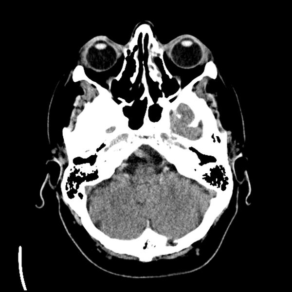 File:Acute A3 occlusion with ACA ischemic penumbra (CT perfusion) (Radiopaedia 72036-82525 Axial non-contrast 8).jpg