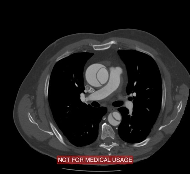 File:Acute aortic dissection - Stanford type A (Radiopaedia 40661-43285 Axial C+ arterial phase 24).jpg
