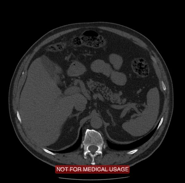 File:Acute aortic dissection - Stanford type A (Radiopaedia 40661-43285 Axial non-contrast 83).jpg