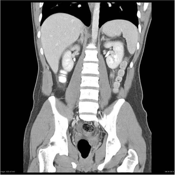 File:Acute appendicitis (Radiopaedia 25364-25615 C+ portal venous phase 19).jpg