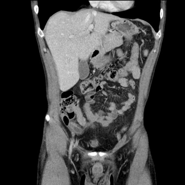 File:Acute appendicitis (Radiopaedia 27049-27227 Coronal C+ portal venous phase 17).jpg