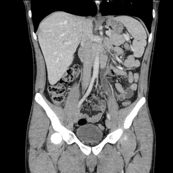 File:Acute appendicitis (Radiopaedia 27049-27227 Coronal C+ portal venous phase 26).jpg