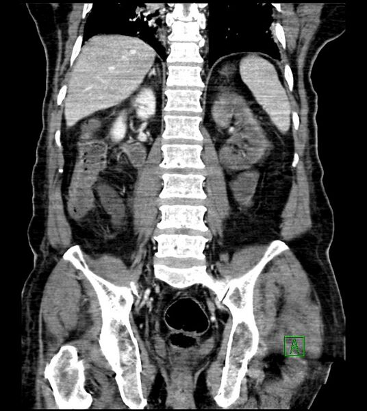 File:Acute arterial mesenteric ischemia (Radiopaedia 78238-90828 Coronal C+ portal venous phase 63).jpg