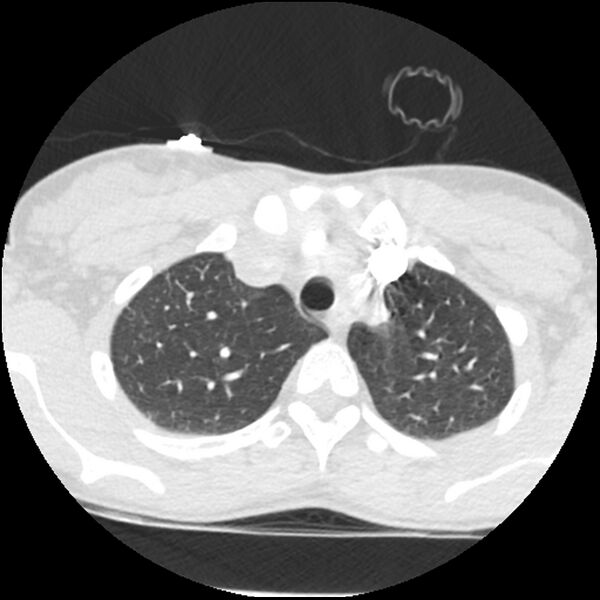 File:Acute chest syndrome - sickle cell disease (Radiopaedia 42375-45499 Axial lung window 41).jpg