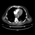 Acute heart failure (CT) (Radiopaedia 79835-93075 Axial C+ arterial phase 32).jpg