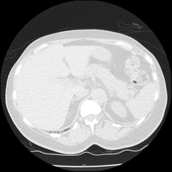 File:Acute interstitial pneumonitis (Radiopaedia 45404-49444 Axial lung window 98).jpg