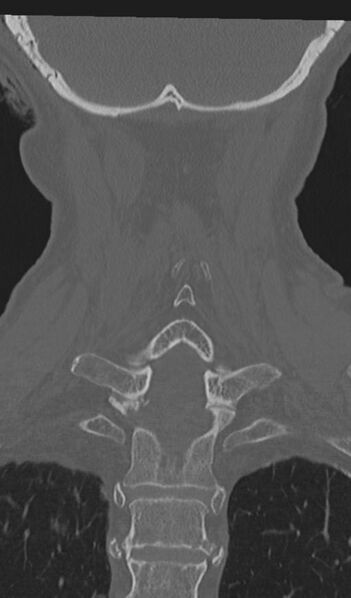 File:Acute on chronic subdural hematoma and thoracic vertebral injury in a multitrauma patient (Radiopaedia 31698-32619 Coronal bone window 49).jpg