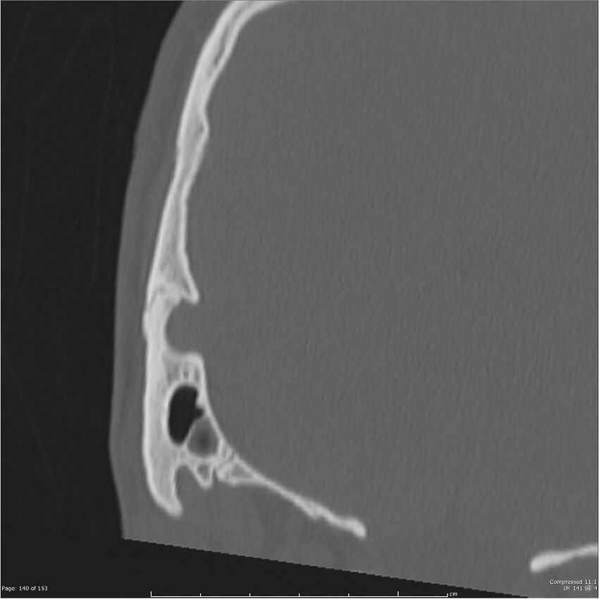 Acute otomastoiditis (Radiopaedia 28276-28512 Coronal PTB bone window reformat 71).jpg