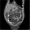 Acute pancreatitis (Radiopaedia 19135-19116 Coronal non-contrast 7).jpg
