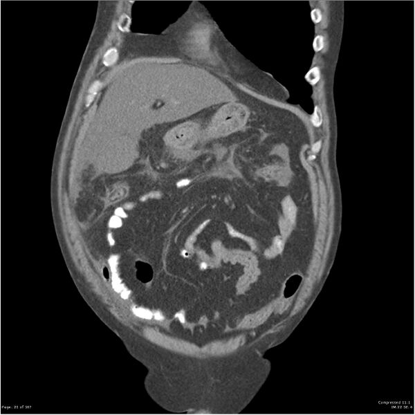 File:Acute pancreatitis (Radiopaedia 19135-19116 Coronal non-contrast 7).jpg