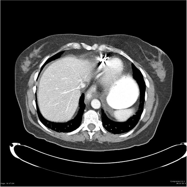 File:Acute pancreatitis (Radiopaedia 19136-19117 Axial C+ portal venous phase 2).jpg