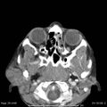 Acute parotitis (Radiopaedia 54123-60294 Axial C+ arterial phase 9).jpg
