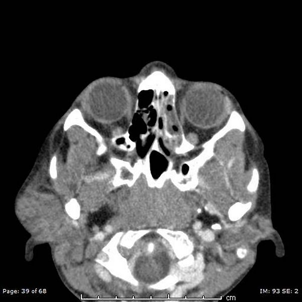 File:Acute parotitis (Radiopaedia 54123-60294 Axial C+ arterial phase 9).jpg