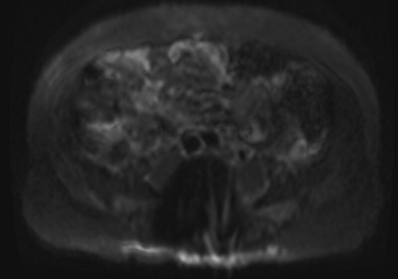 File:Acute portal vein thrombosis (Radiopaedia 73198-83925 Axial DWI 28).jpg