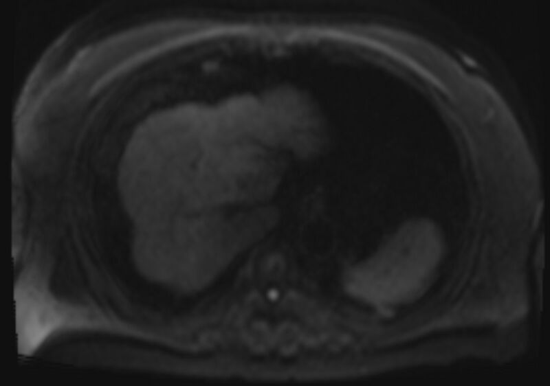 File:Acute portal vein thrombosis (Radiopaedia 73198-83925 Axial DWI 38).jpg