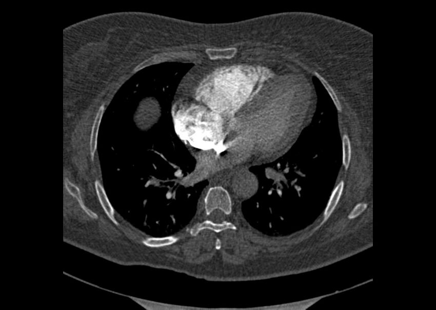 Acute pulmonary embolism (Radiopaedia 29938-30466 Axial C+ CTPA 128).jpg