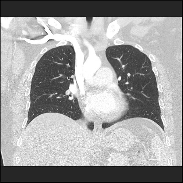 File:Acute pulmonary embolism with pulmonary infarct (Radiopaedia 73062-83768 Coronal lung window 36).jpg