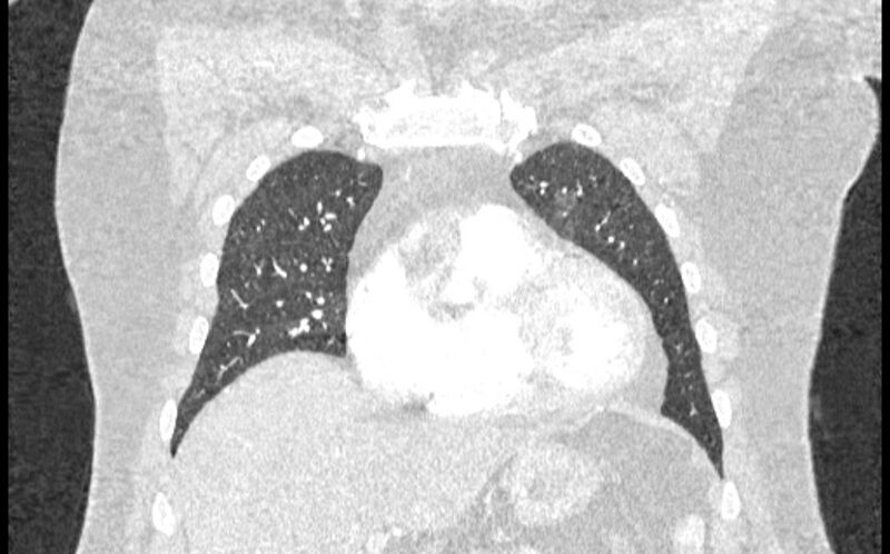 File:Acute pulmonary embolism with pulmonary infarcts (Radiopaedia 77688-89908 Coronal lung window 16).jpg