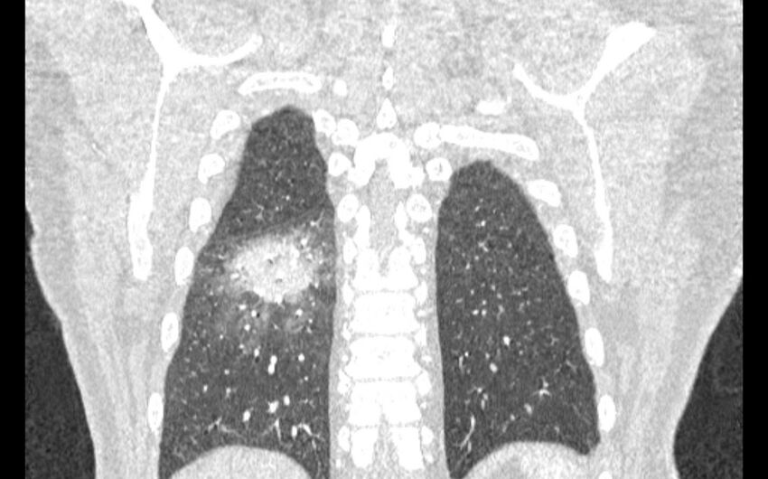 Acute pulmonary embolism with pulmonary infarcts (Radiopaedia 77688-89908 Coronal lung window 87).jpg