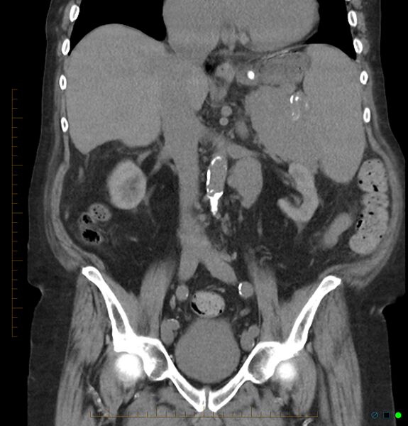 File:Acute renal failure post IV contrast injection- CT findings (Radiopaedia 47815-52557 Coronal non-contrast 24).jpg