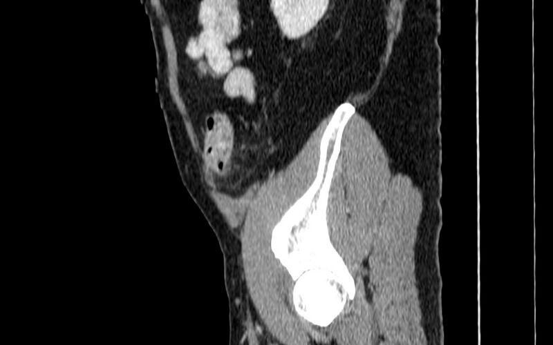 File:Acute sigmoid colon diverticulitis (Radiopaedia 55507-61976 Sagittal C+ portal venous phase 110).jpg