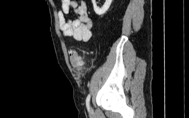 File:Acute sigmoid colon diverticulitis (Radiopaedia 55507-61976 Sagittal C+ portal venous phase 87).jpg