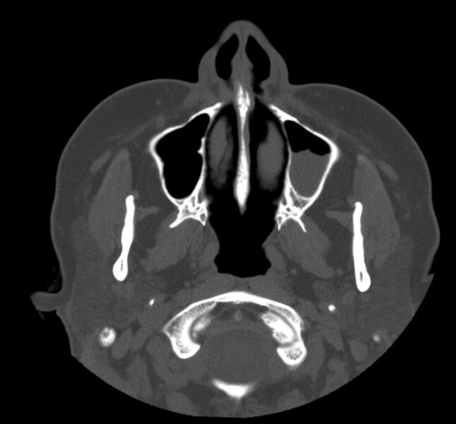 File:Acute sinusitis (Radiopaedia 22419-22455 Axial non-contrast 6).jpg