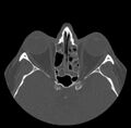 Acute sinusitis (Radiopaedia 23161-23215 Axial bone window 46).jpg