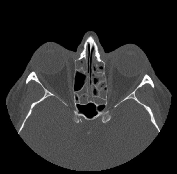 File:Acute sinusitis (Radiopaedia 23161-23215 Axial bone window 46).jpg