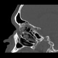 Acute sinusitis (Radiopaedia 23161-23215 Sagittal bone window 26).jpg