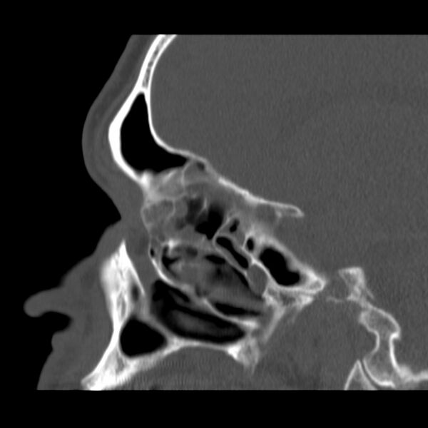 File:Acute sinusitis (Radiopaedia 23161-23215 Sagittal bone window 26).jpg