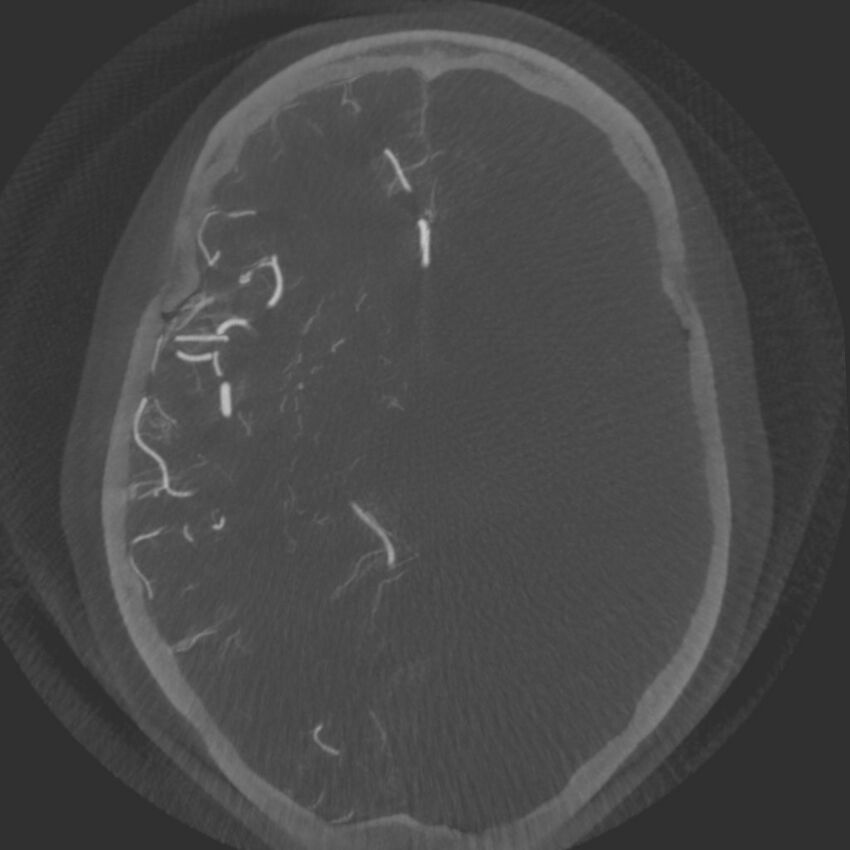 Acute subarachnoid hemorrhage and accessory anterior cerebral artery (Radiopaedia 69231-79010 Axial arterial - MIP 39).jpg
