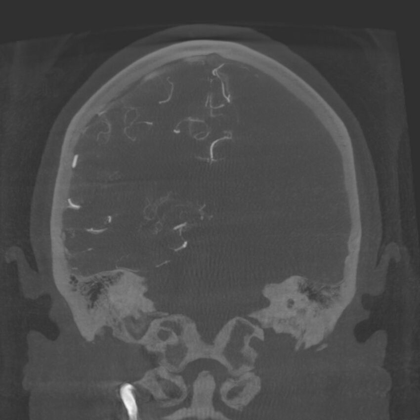 Acute subarachnoid hemorrhage and accessory anterior cerebral artery (Radiopaedia 69231-79010 Coronal arterial - MIP 65).jpg
