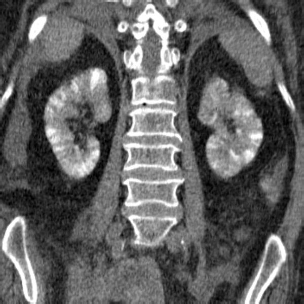 File:Acute tubular necrosis (Radiopaedia 28077-28334 Coronal non-contrast 21).jpg