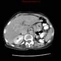 Adenocarcinoma of the colon (Radiopaedia 8191-9039 Axial renal excretory phase 9).jpg