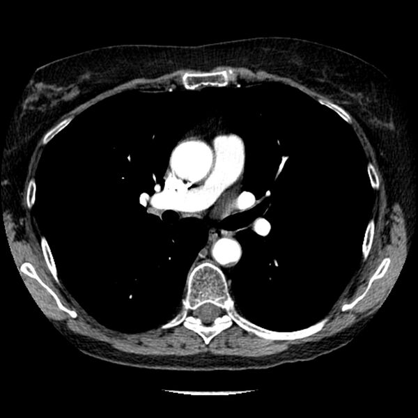 File:Adenocarcinoma of the lung (Radiopaedia 41015-43755 Axial C+ portal venous phase 55).jpg