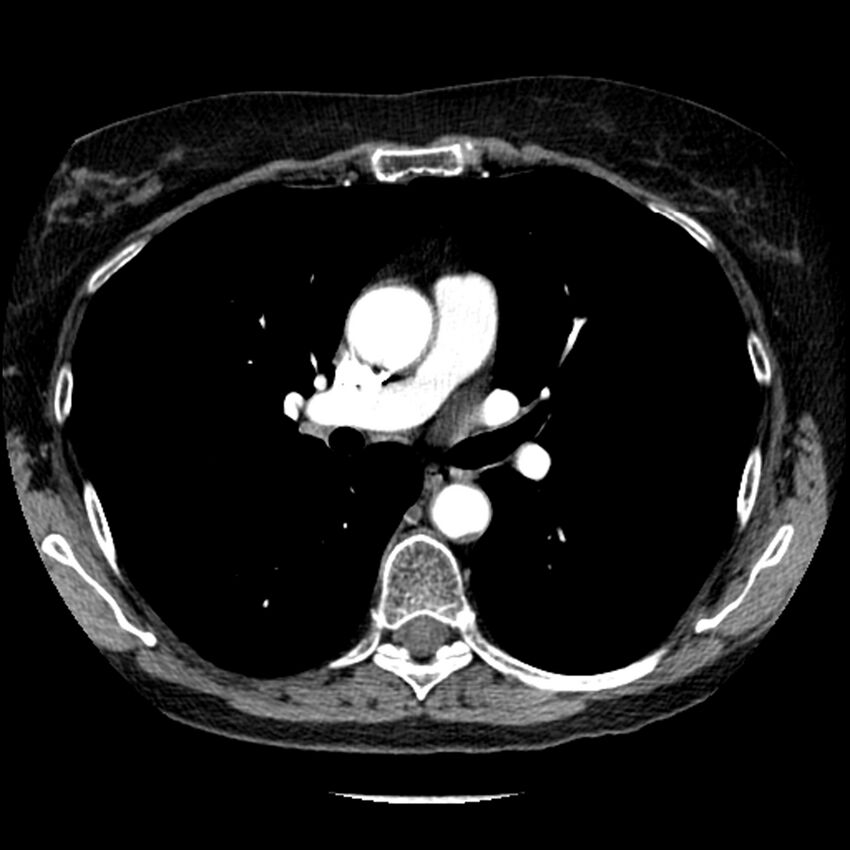 Adenocarcinoma of the lung (Radiopaedia 41015-43755 Axial C+ portal venous phase 55).jpg