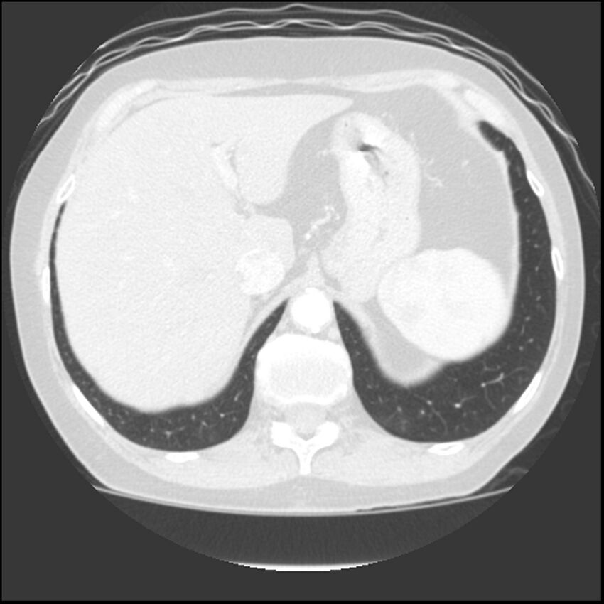 Adenocarcinoma of the lung (Radiopaedia 41015-43755 Axial lung window 112).jpg