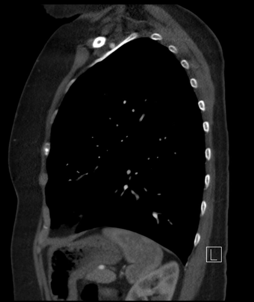 Adenocarcinoma of the lung (Radiopaedia 44205-47803 Sagittal C+ portal venous phase 16).jpg