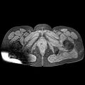 Adenomyoma of the uterus (huge) (Radiopaedia 9870-10438 Axial T1 fat sat 4).jpg